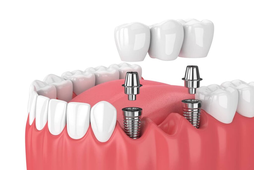 How Long Do Dental Bridges