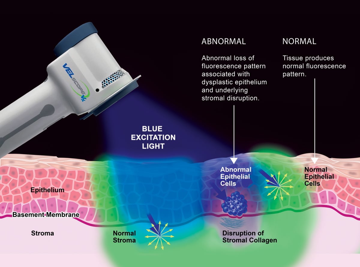 VELscope Mechanism of action Illustration v03