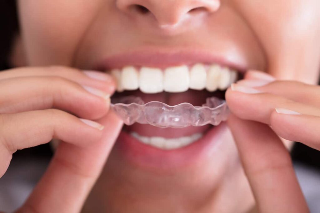 how do you clean invisalign retainers