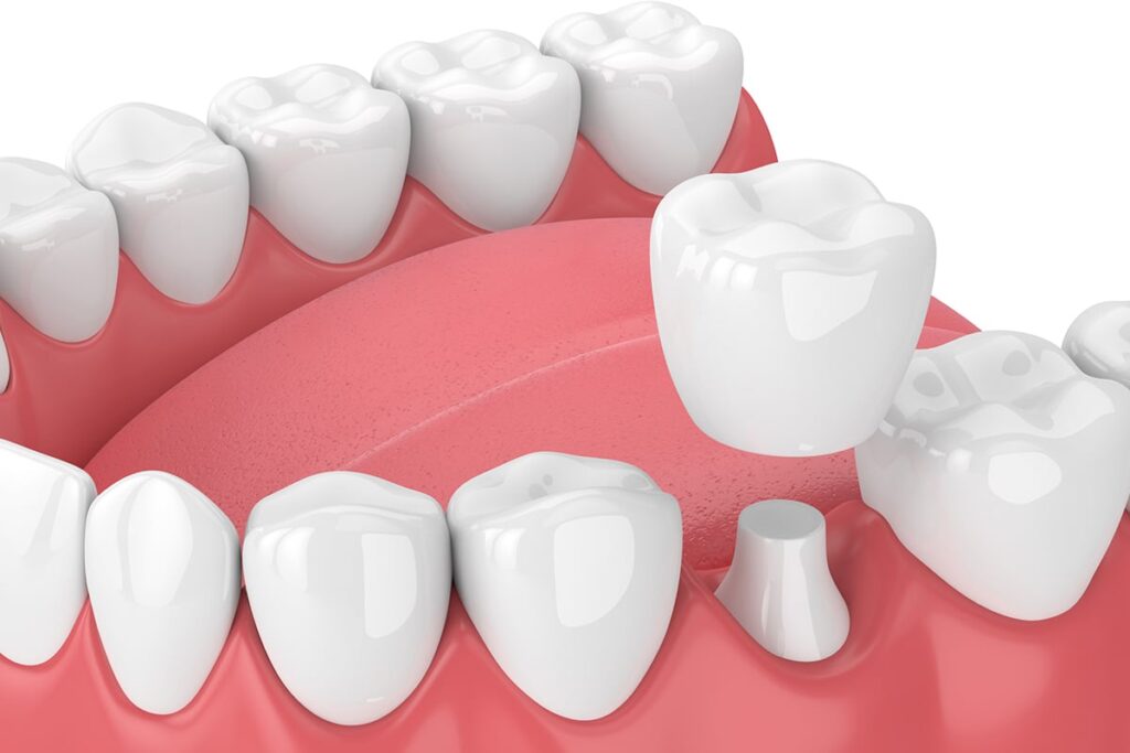 How Long Does It Take To Get A Dental Crown?