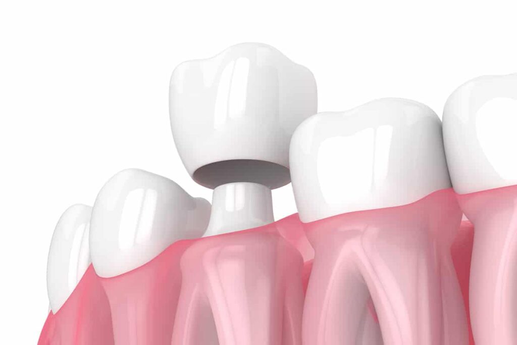 how long should your tooth be sensitive after getting a crown blog