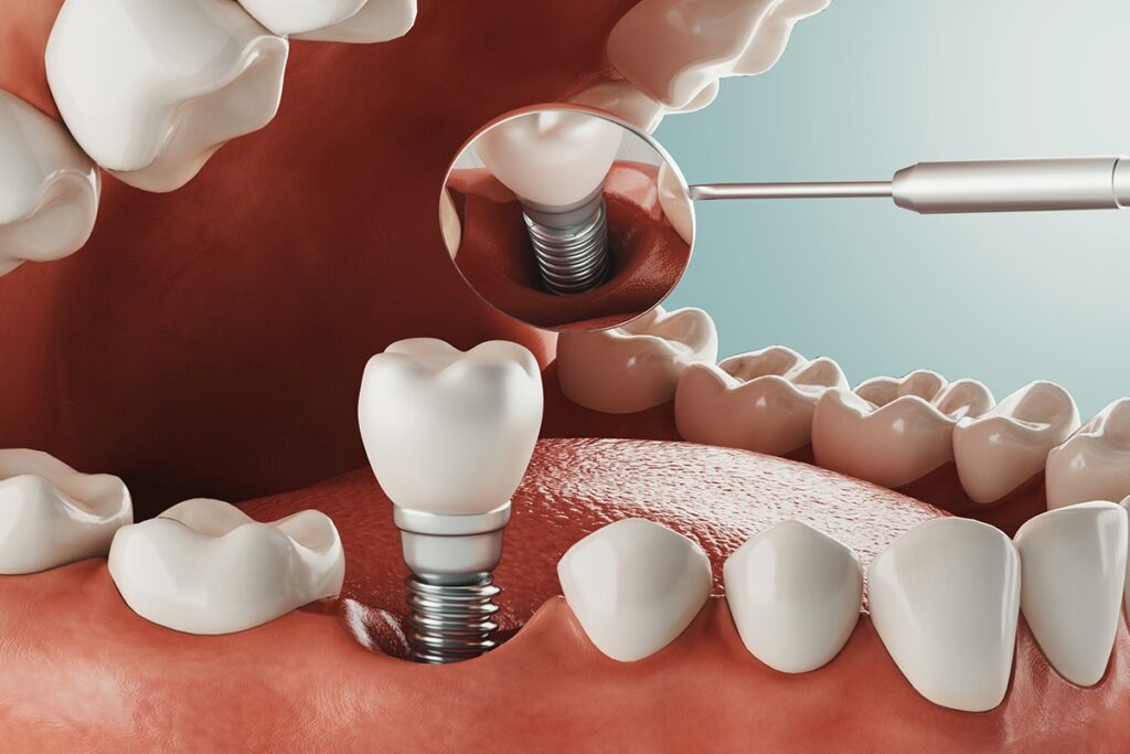 how long will the pain last after getting a dental implant