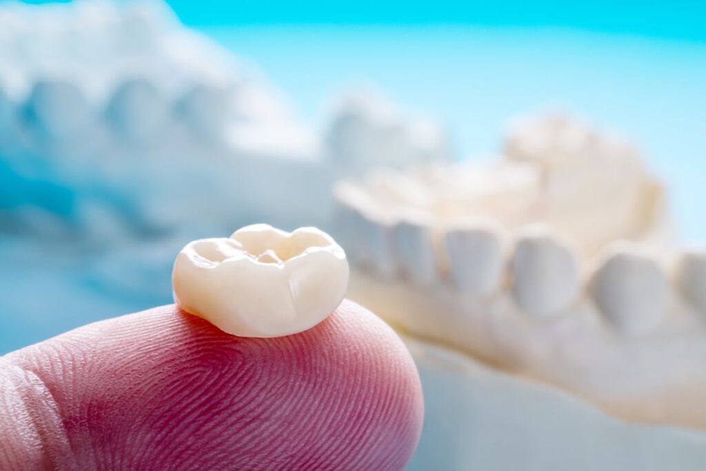 how much tooth structure is needed for a crown blog