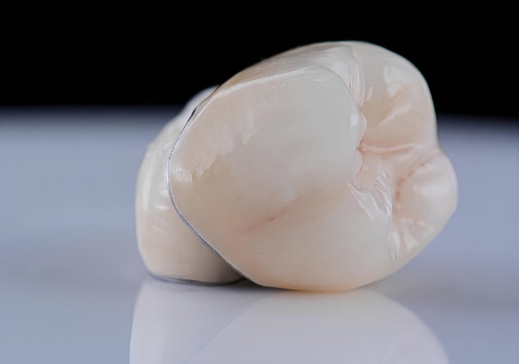 Top 5 Reasons to Consider Same-Day Crowns for Dental Restoration